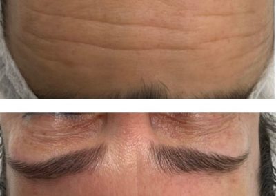 prima e dopo trattamento rughe